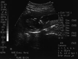 November 21, 2002 sonogram. Click for details.